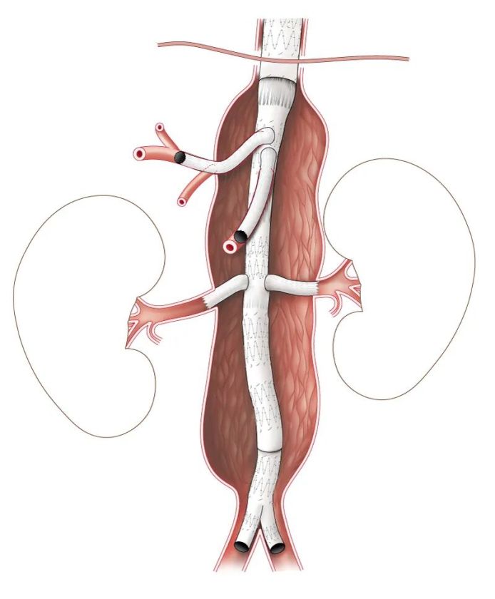 Panevėžyje pirmą kartą atlikta unikali gelbėjimo operacija dėl plyšusios aortos